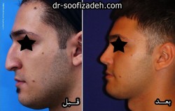 رینوبلاستی الدكتور صوفي زادة