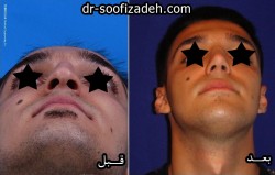 تجميل الأنف للرجال