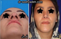 جراحة تجميل الأنف