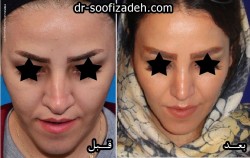 رینوبلاستی