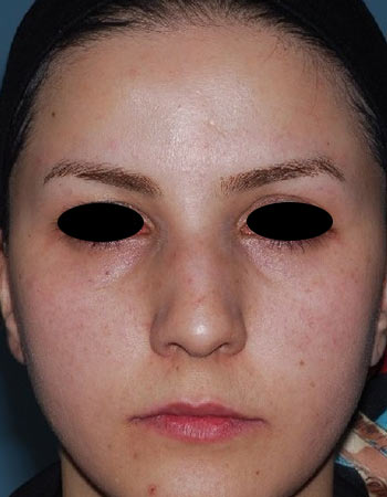 nose-24