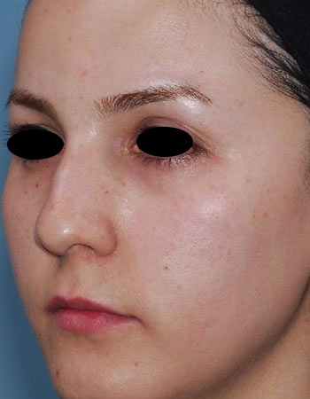 nose-32