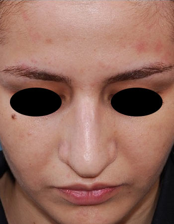 nose-38