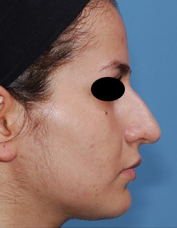 nose-39