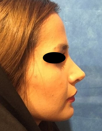 nose-40